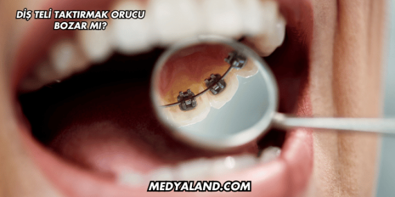 Diş Teli Taktırmak Orucu Bozar mı?