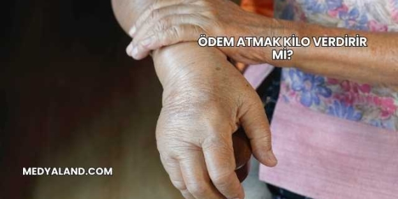Ödem Atmak Kilo Verdirir mi?