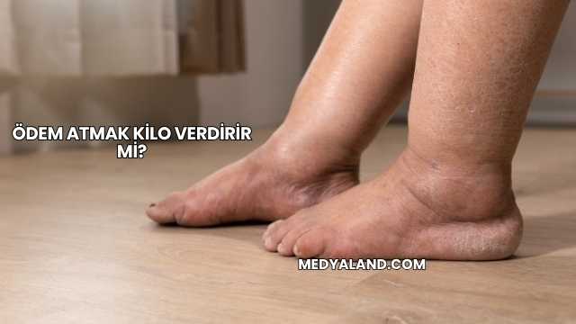 Ödem Atmak Kilo Verdirir mi?