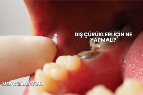 Diş Çürükleri İçin Ne Yapmalı?