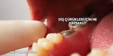 Diş Çürükleri İçin Ne Yapmalı?