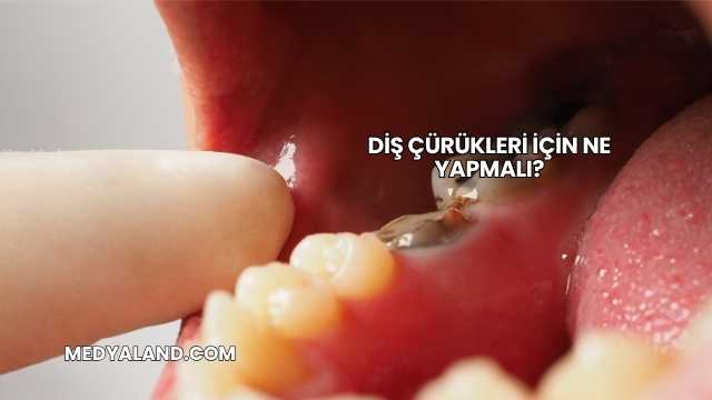 Diş Çürükleri İçin Ne Yapmalı?