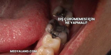 Diş Çürümemesi İçin Ne Yapmalı?