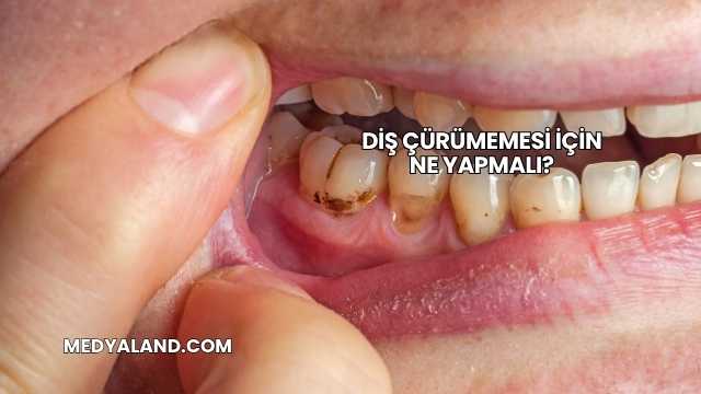 Diş Çürümemesi İçin Ne Yapmalı?