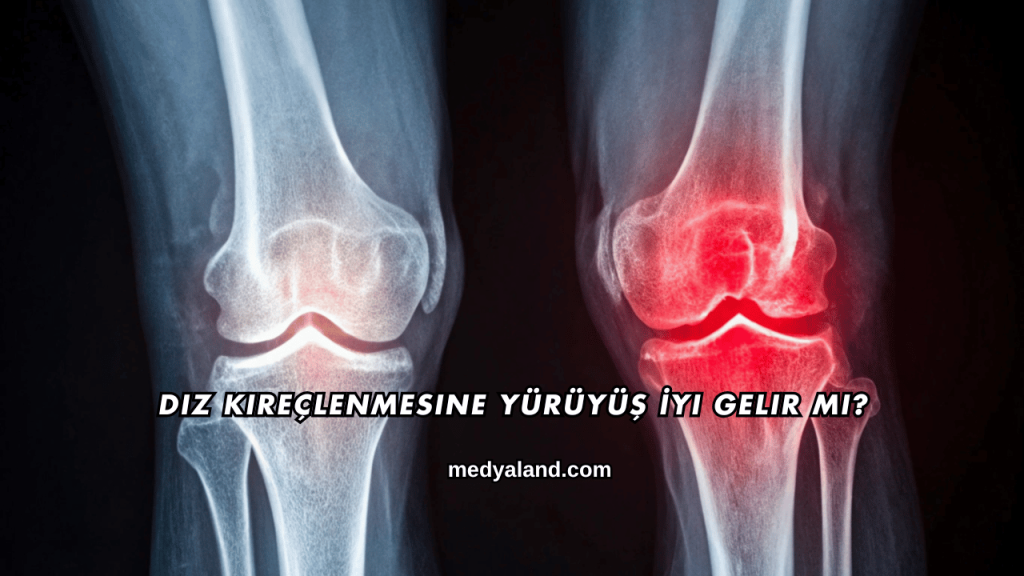 Diz Kireçlenmesine Yürüyüş İyi Gelir mi?