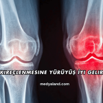 Diz Kireçlenmesine Yürüyüş İyi Gelir mi?