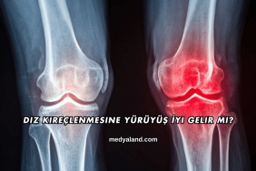 Diz Kireçlenmesine Yürüyüş İyi Gelir mi?