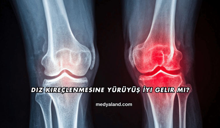 Diz Kireçlenmesine Yürüyüş İyi Gelir mi?