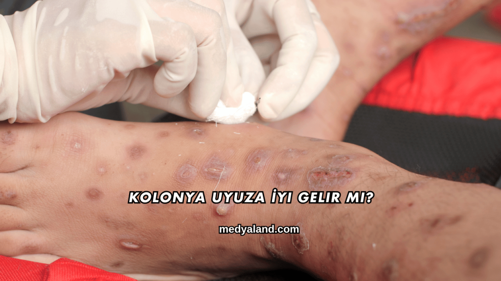 Kolonya Uyuza İyi Gelir mi?