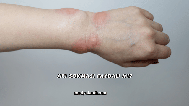 Arı Sokması Faydalı mı?