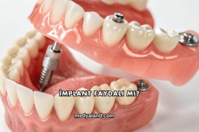 İmplant Faydalı mı?