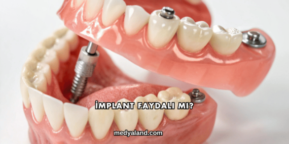 İmplant Faydalı mı?