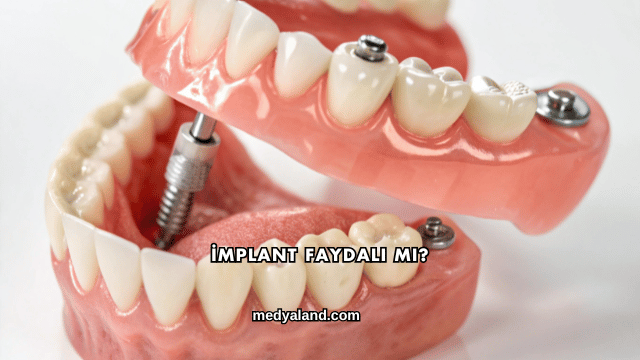 İmplant Faydalı mı?