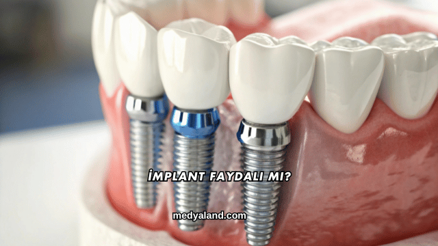 İmplant Faydalı mı?