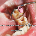 Kanal Tedavisi Sonrası Su İçilir mi?