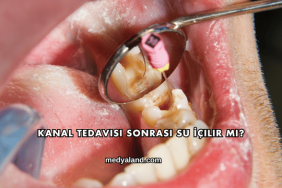 Kanal Tedavisi Sonrası Su İçilir mi?