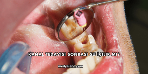 Kanal Tedavisi Sonrası Su İçilir mi?