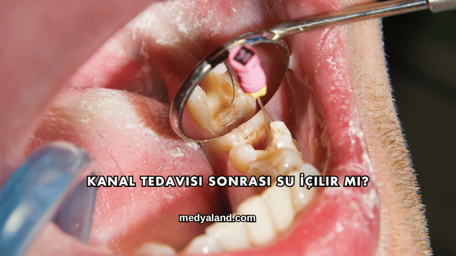 Kanal Tedavisi Sonrası Su İçilir mi?