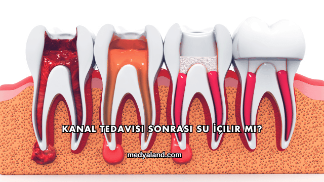 Kanal Tedavisi Sonrası Su İçilir mi?